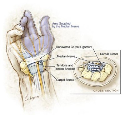 Carpal Tunnel Syndrome | Orthopedic Doctors in Grand Rapids, MI